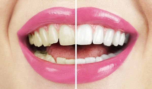 What Early Signs of Oral Cancer Should You Never Ignore Romford?