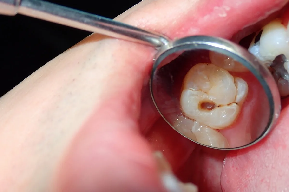 Why Do Teeth Crack? Common Causes to Know Romford
