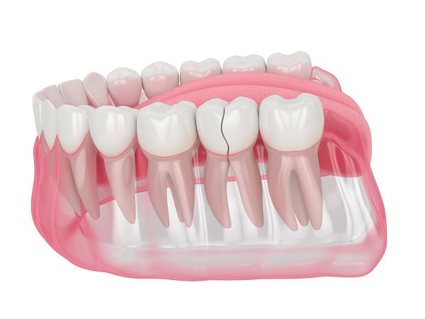 How Can You Manage Pain and Discomfort After a Root Canal Romford?