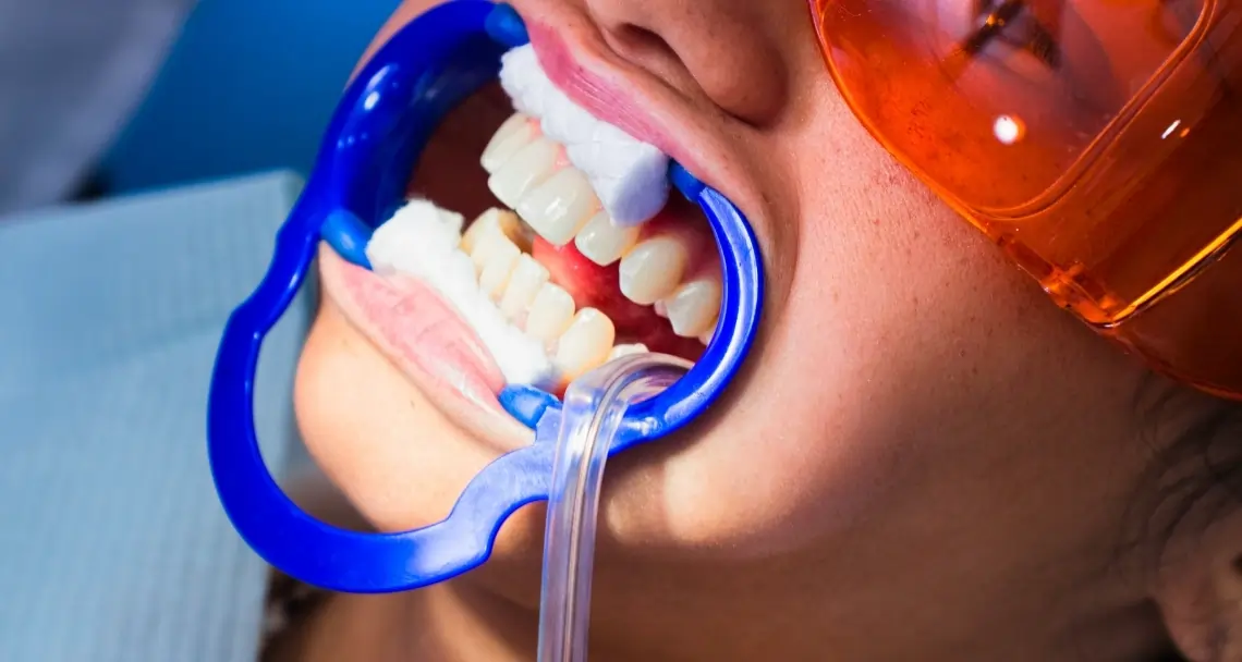 How Teeth Whitening Treatments Actually Work on Your Enamel Romford