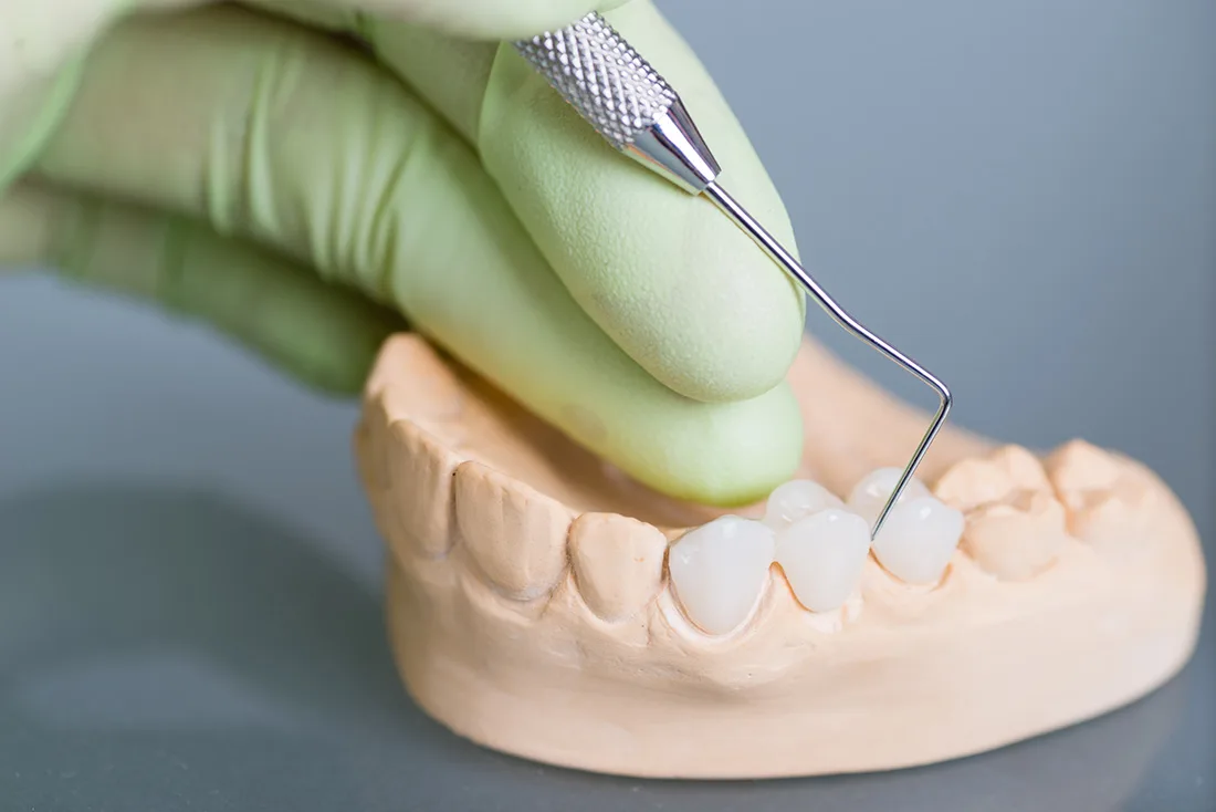 What Are the Different Types of Dental Crowns Available Romford?