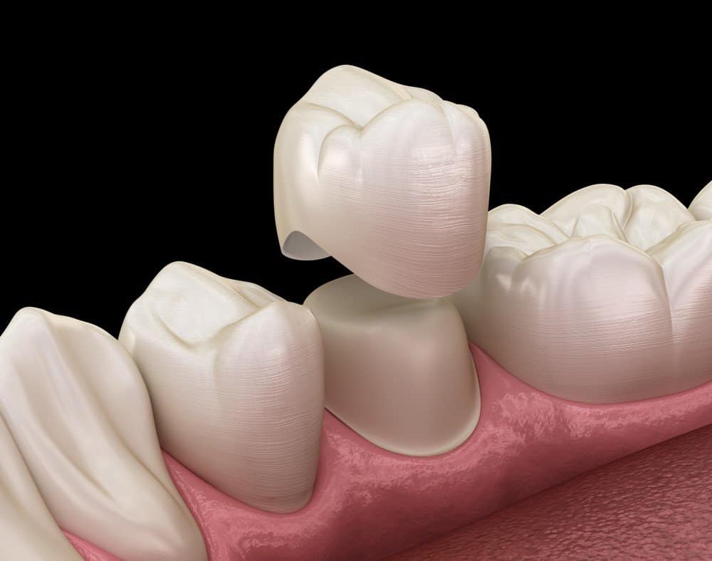What Daily Habits Help Protect Your Dental Crowns Romford?