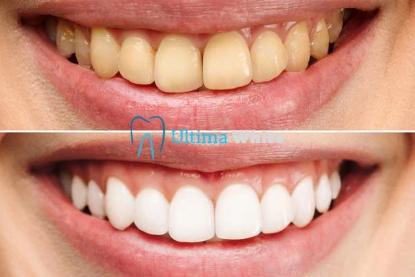 Why Might Multiple Whitening Sessions Be Necessary Romford?