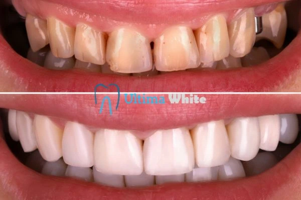 What Makes Instant Teeth Whitening Treatments So Popular Romford?
