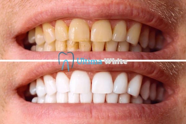 Stained Teeth and Persistent Bad Breath Romford